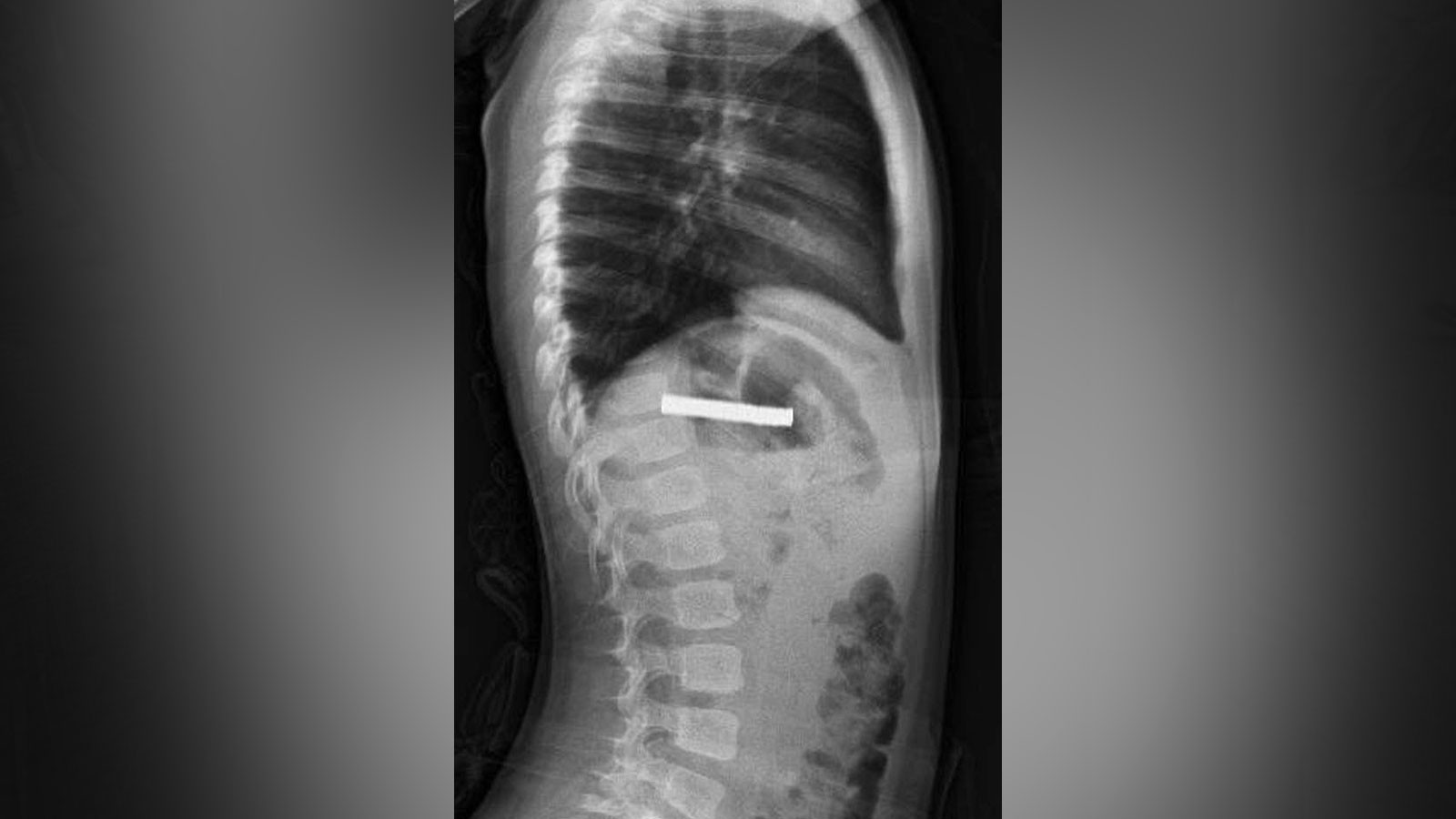 Hepsi, 3 yaşındaki çocuğun yemek borusundan çıkarıldı: Tam 19 adet! Hepsi, 3 yaşındaki çocuğun yemek borusundan çıkarıldı: Tam 19 adet!